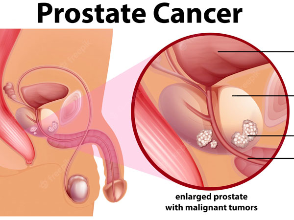 Prostate Cancer Surgeon in Muzaffarnagar