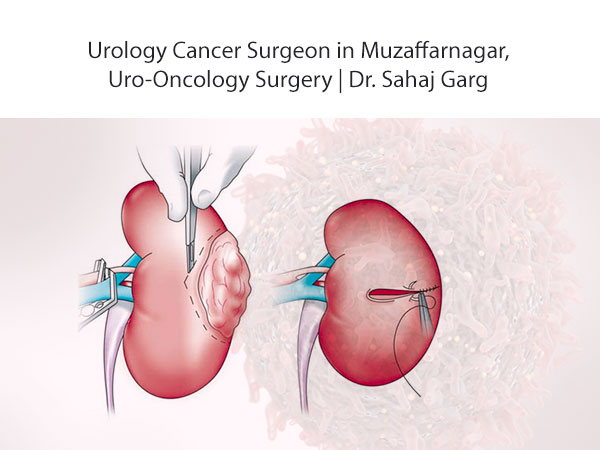 Uro-Oncology Cancer Surgeon in Muzaffarnagar
