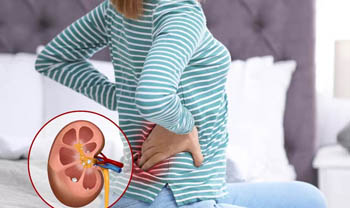 Advancements in Kidney Stone Management