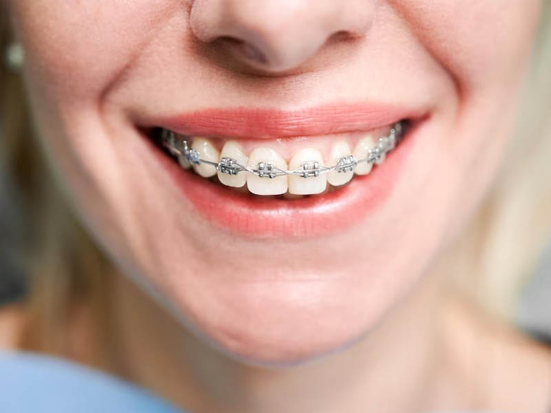 Orthodontic Treatment (Braces & Aligners)