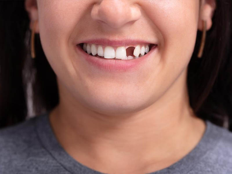 Replacement of missing or damaged teeth