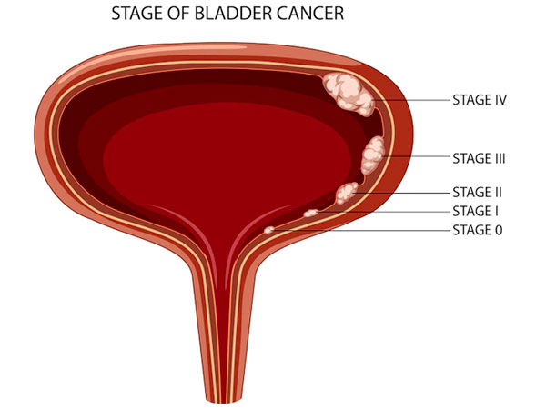 Urinary Bladder Surgeon in Muzaffarnagar