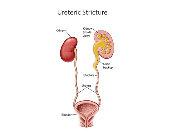 Ureteric Stricture