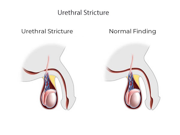 Urethral Stricture Hospital