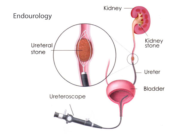 Endourology