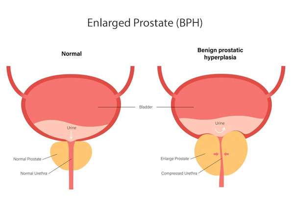 Enlarged Prostate Hospital