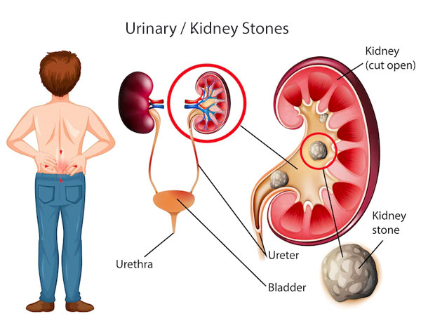 Kidney Stones Hospital