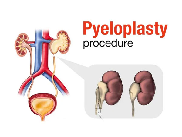 Lap Pyeloplasty