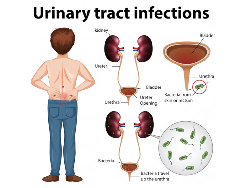 Urinary Tract Infections