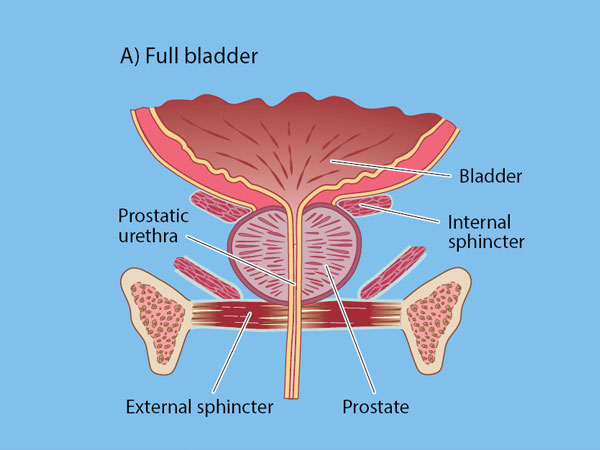 Bladder Neck Reconstruction