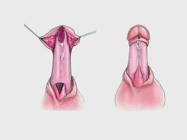 Urethro plasty